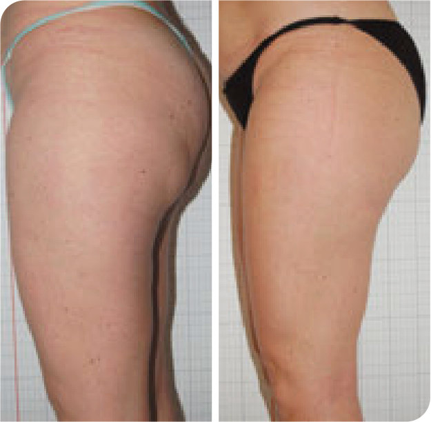 Cellulite an Oberschenkel und Po vorher und nach 8 LYSIWAVE Sitzungen