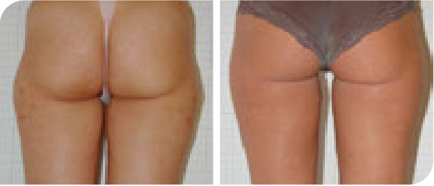 Cellulite am Po vorher und nach 8 LYSIWAVE Sitzungen